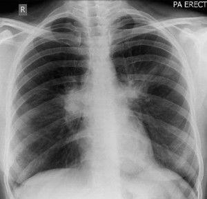 吃瓜有过敏支气管,吃瓜需谨慎
